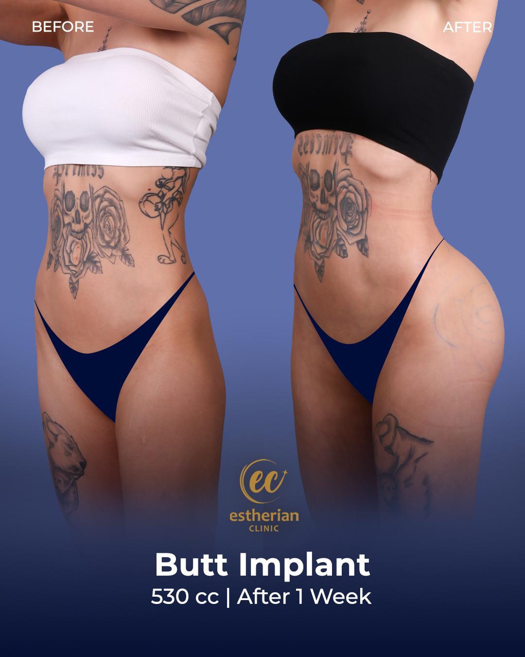 Buttocks Implants Turkey 