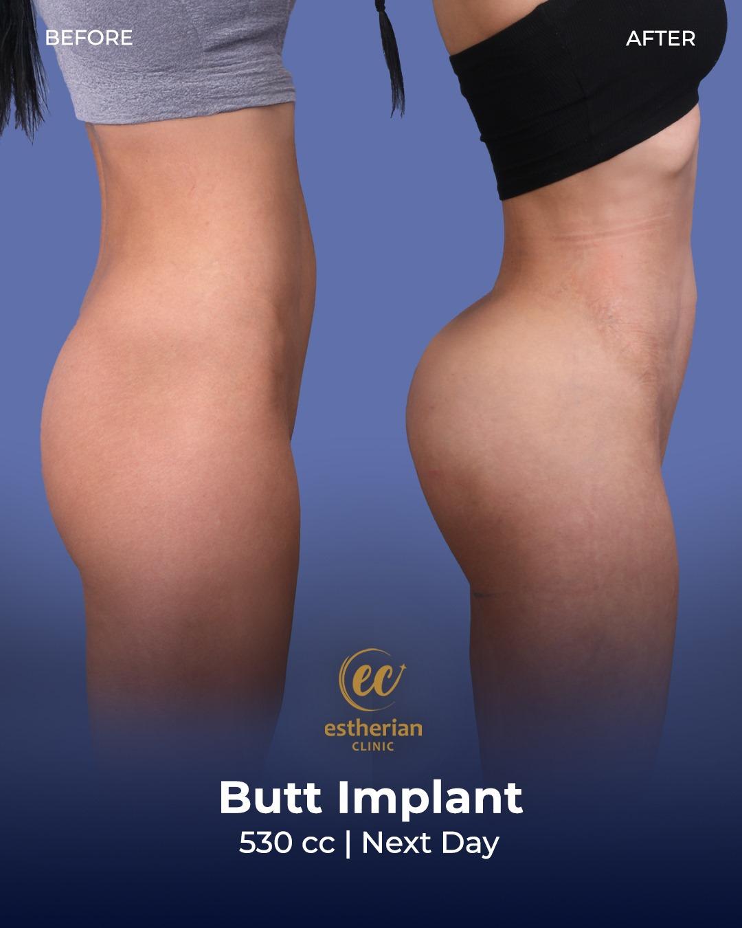 Buttocks Implants Turkey 