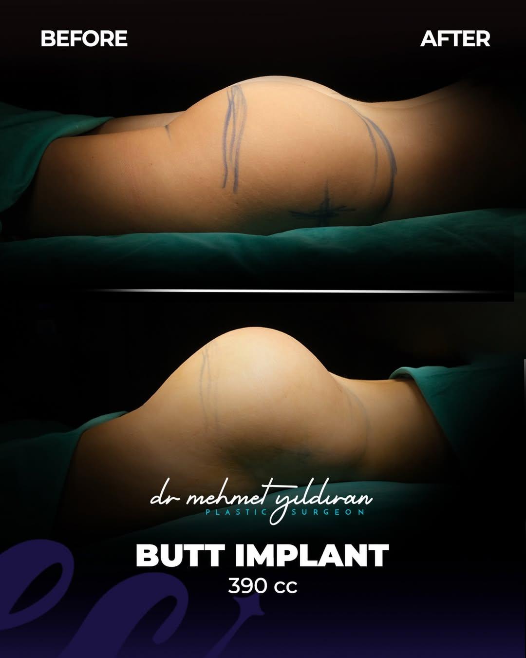 Buttocks Implants Turkey 