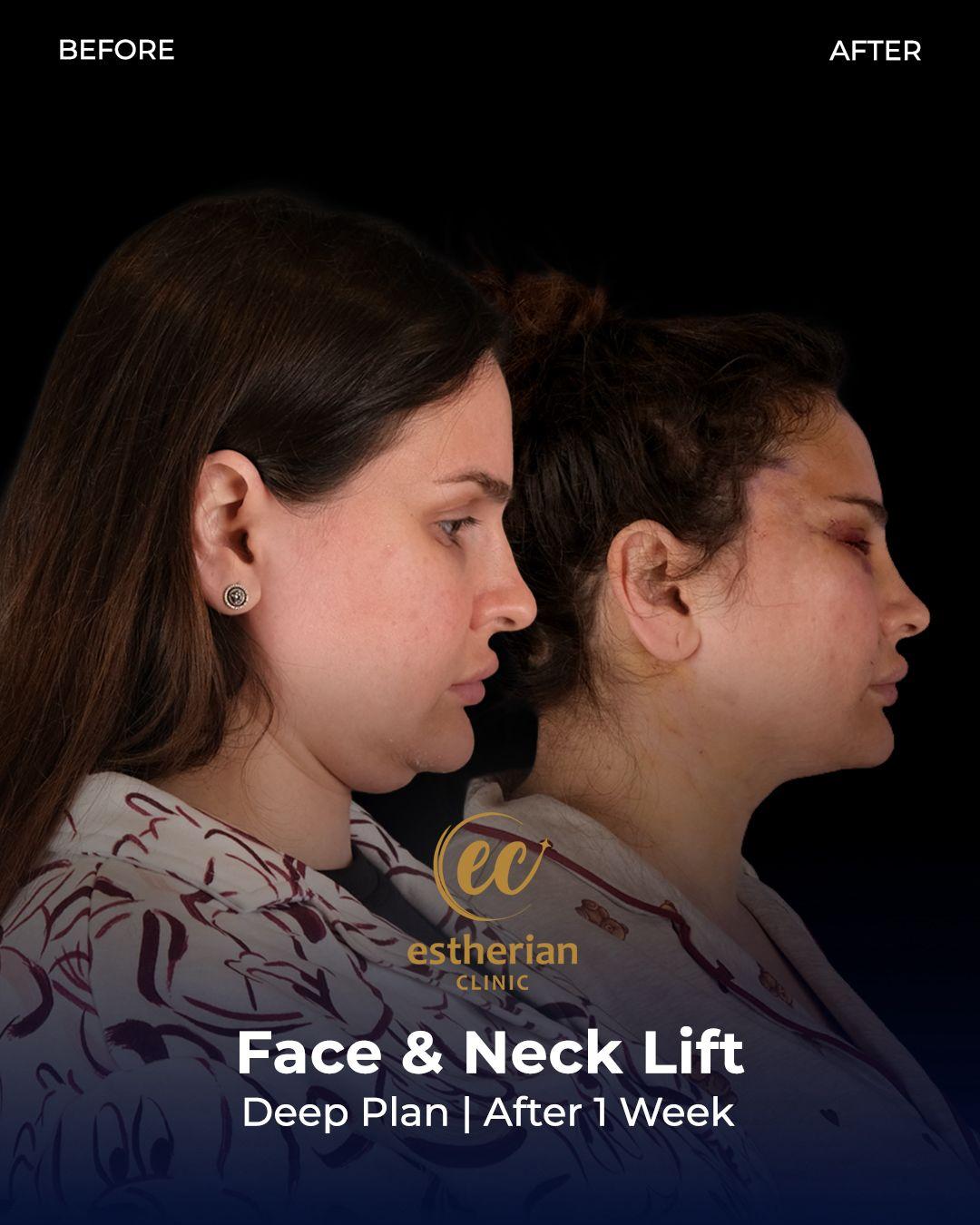 Face lift Turkey 