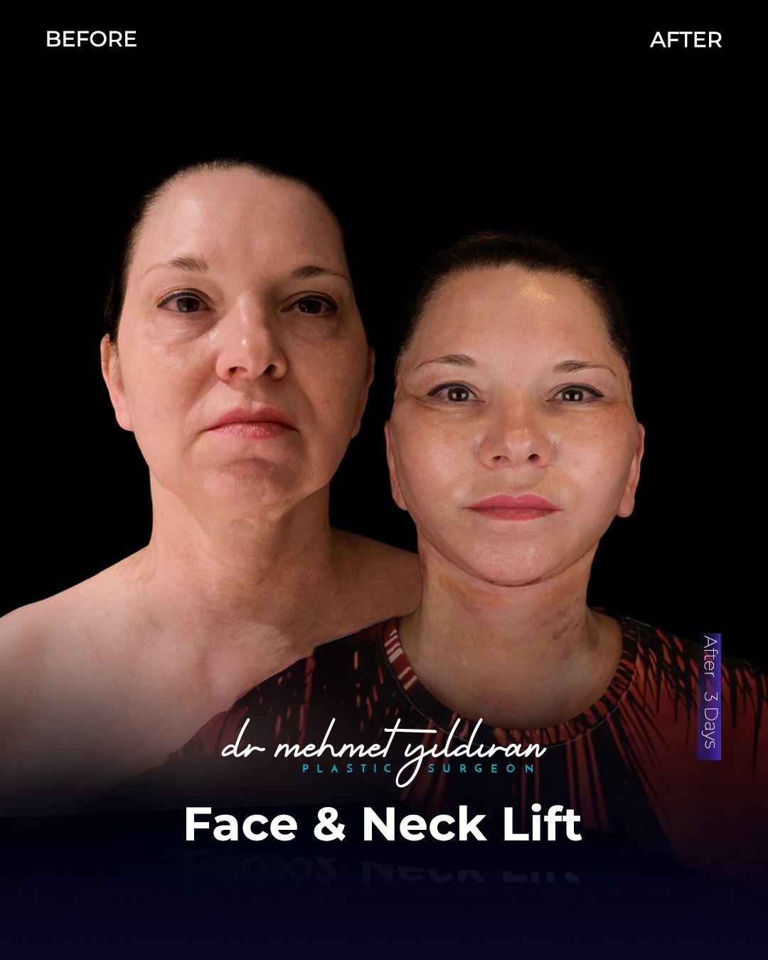 Face lift Turkey 