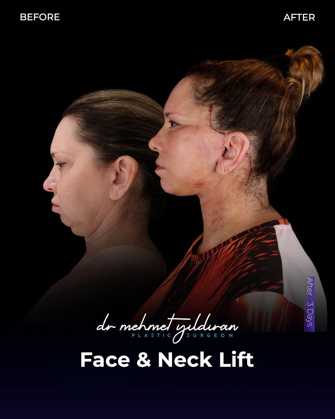Face lift Turkey 