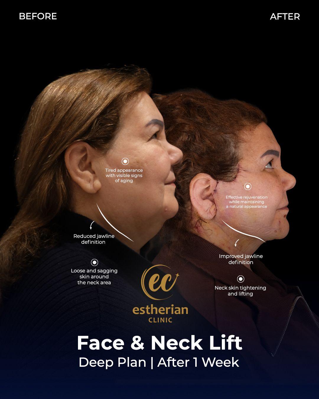 Face lift Turkey 