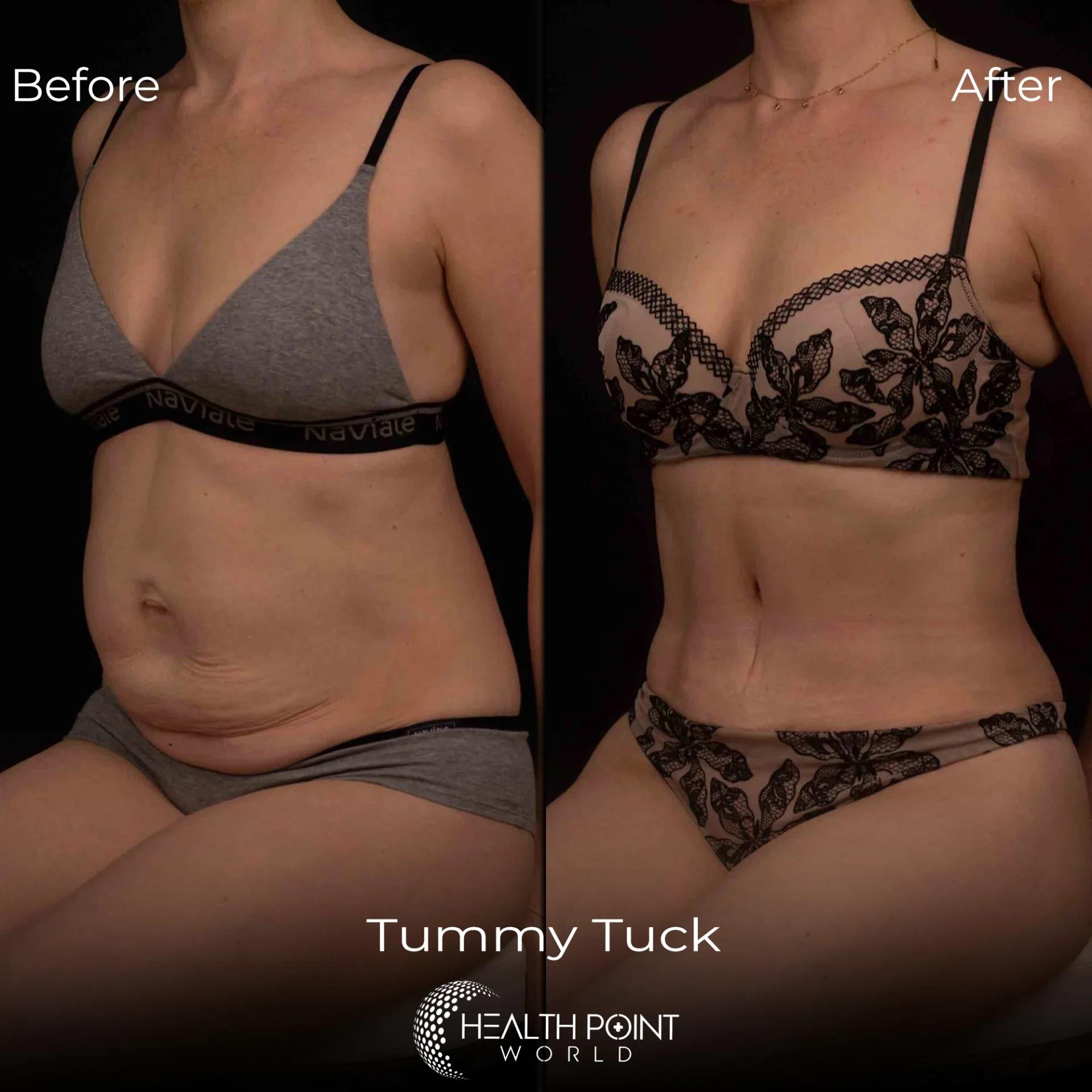 Tummy tuck results Istanbul