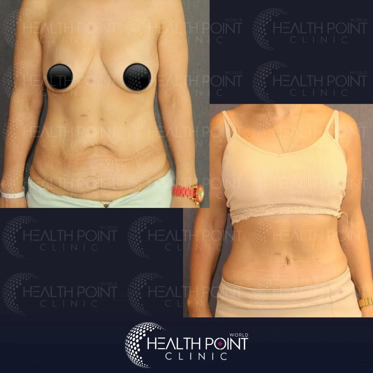 Tummy tuck results Istanbul