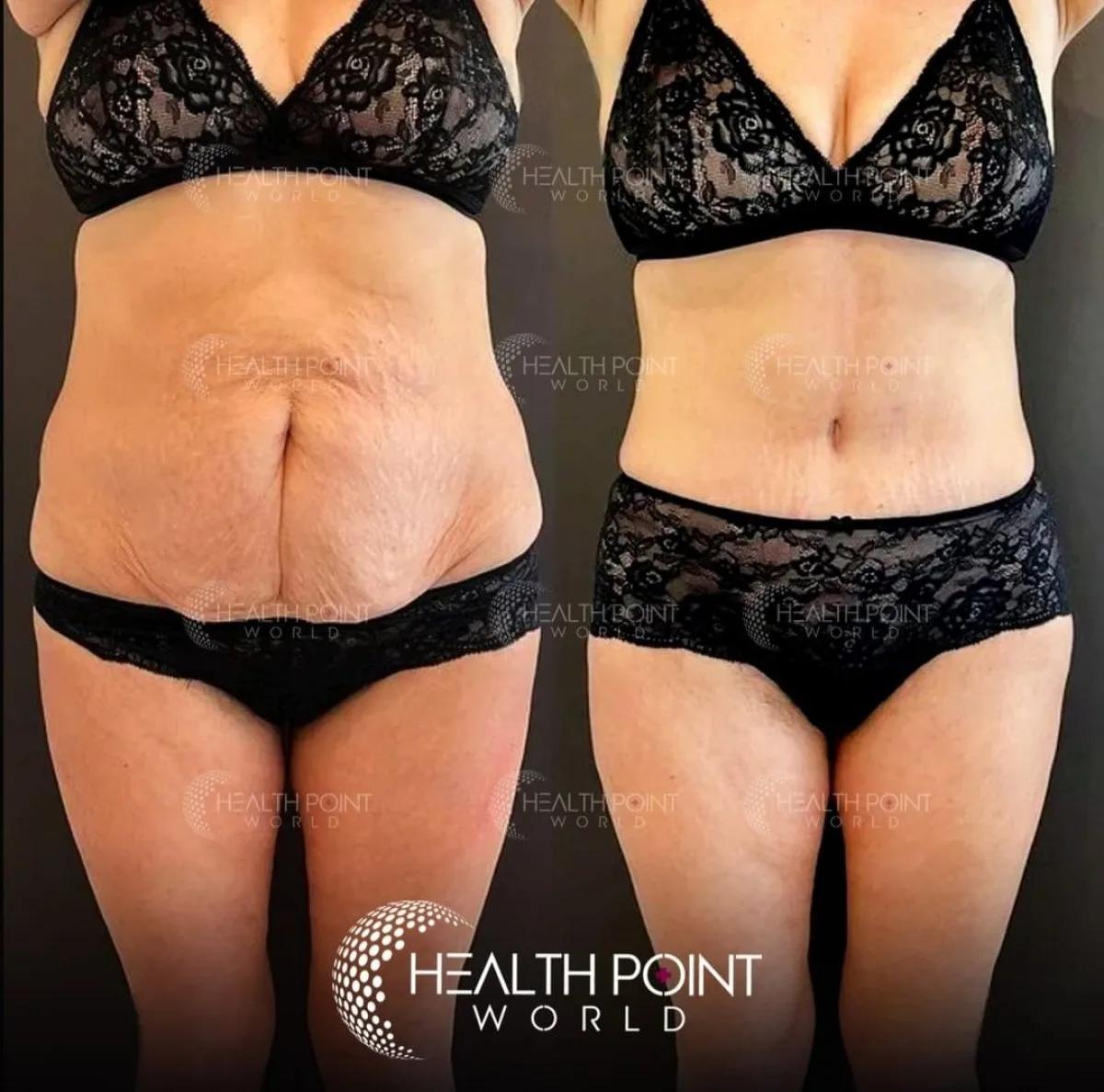 Tummy tuck results Istanbul
