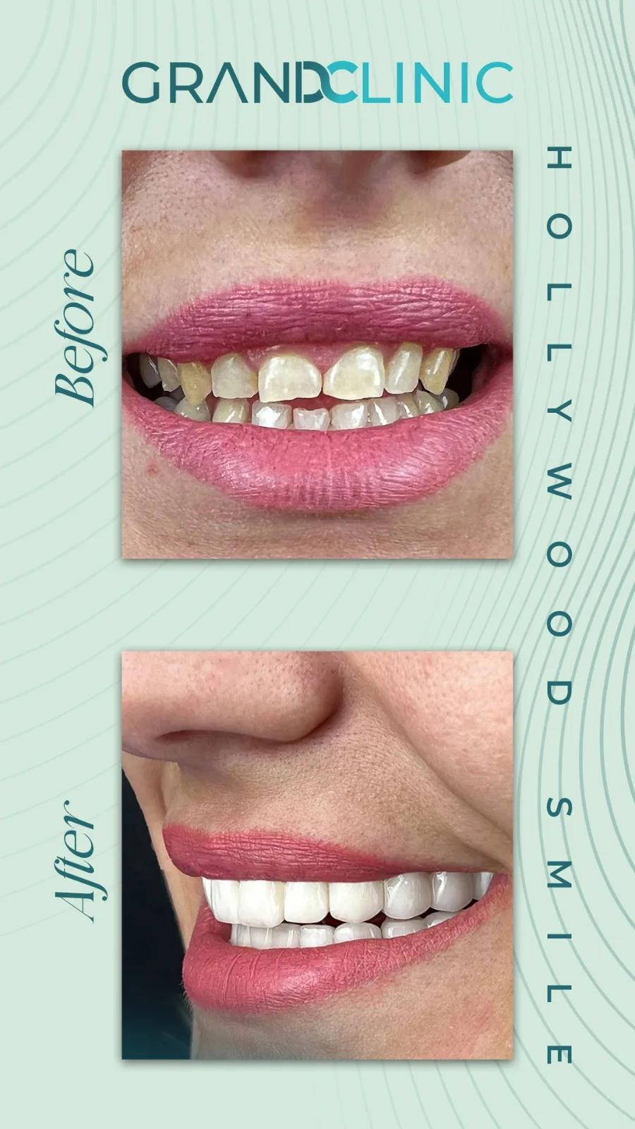 Zirconium crowns