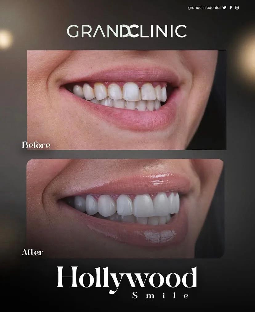 Zirconium crowns
