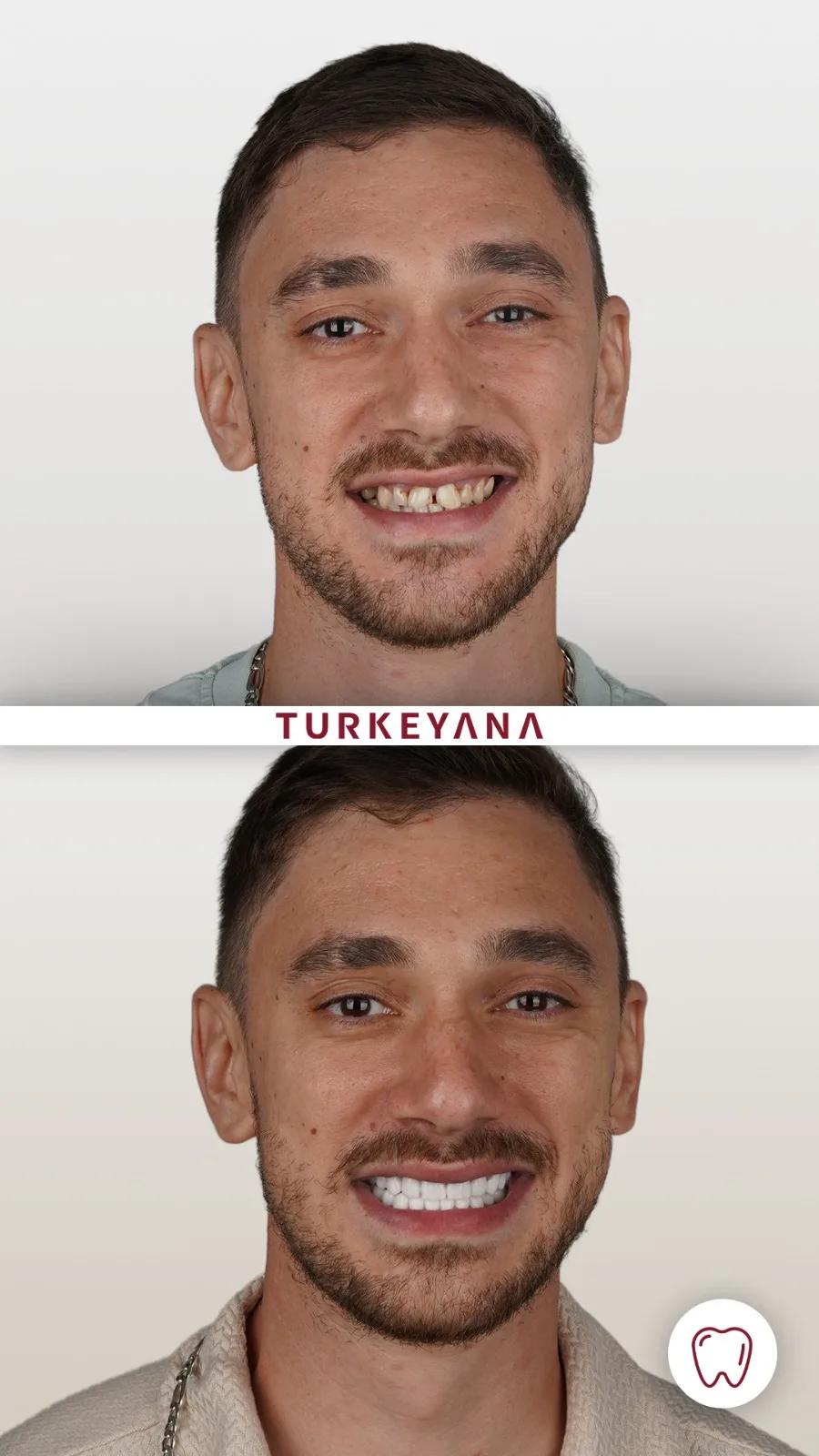 Smile result Istanbul