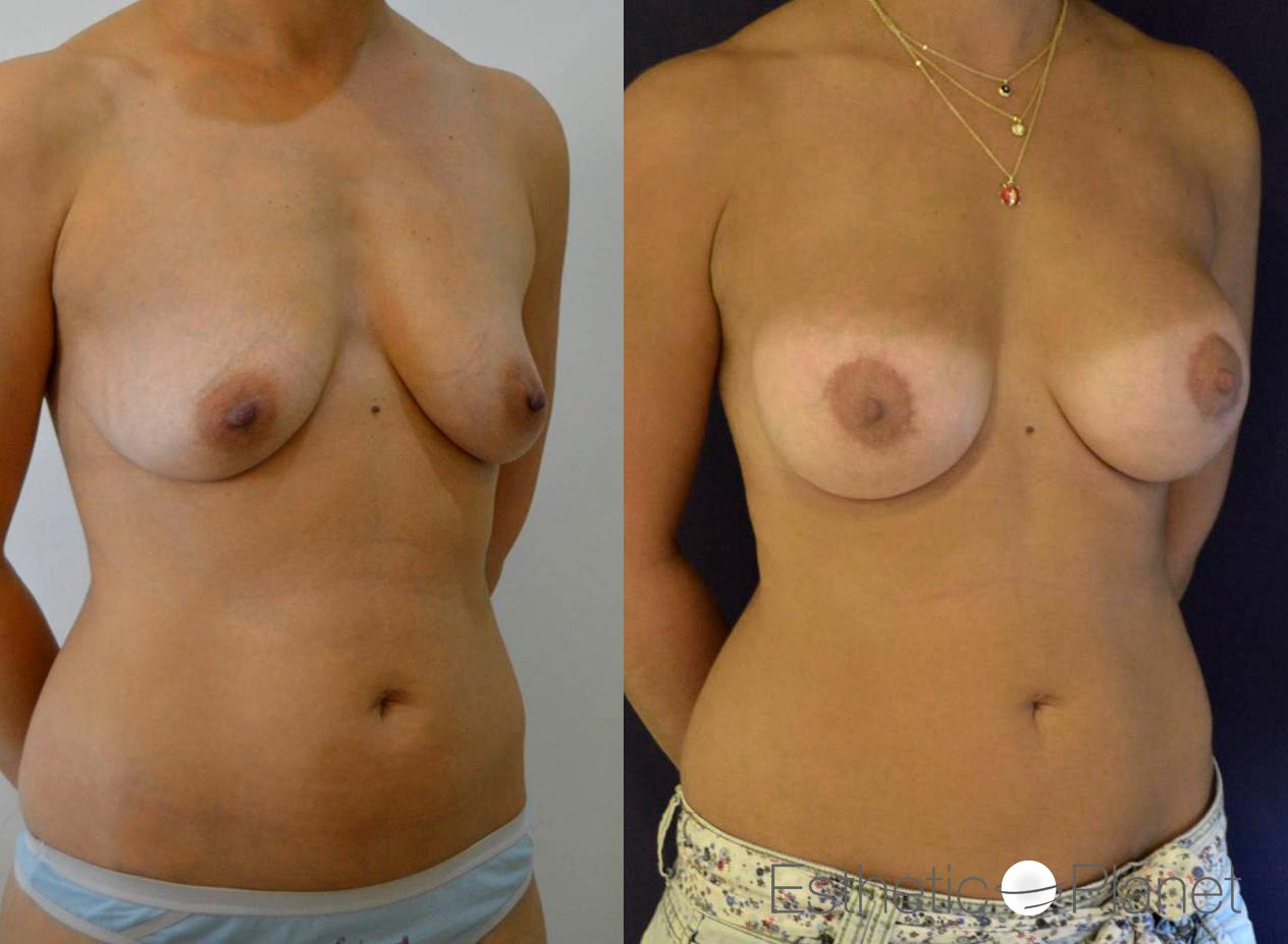 Lifting des seins, breast lift by Dr Ergin Er 
