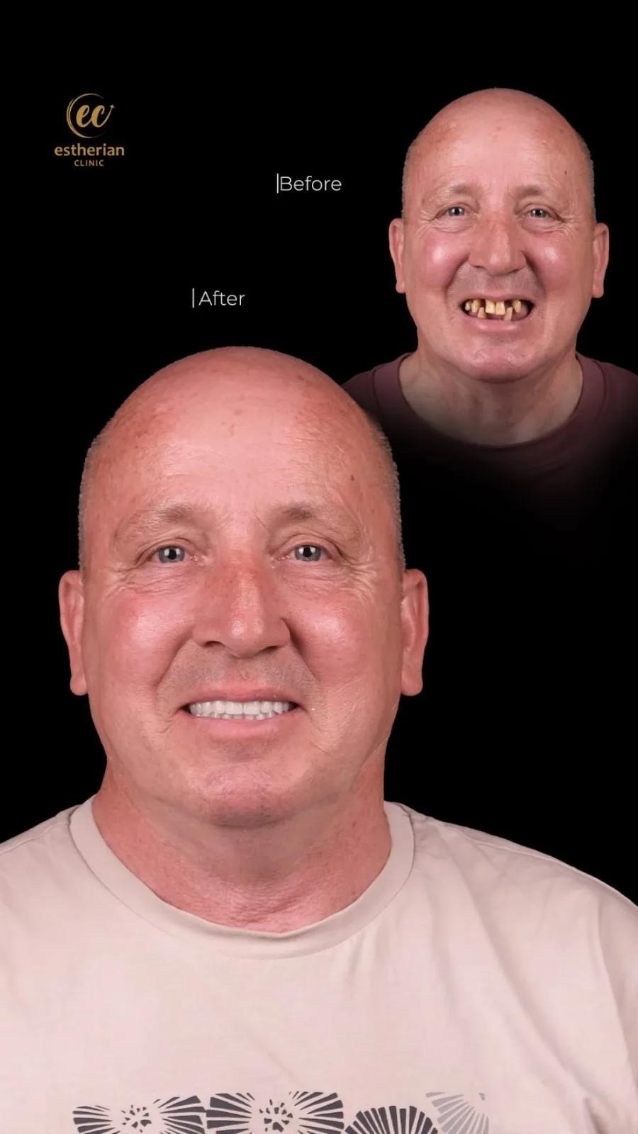 Dental surgery Istanbul Before and after 