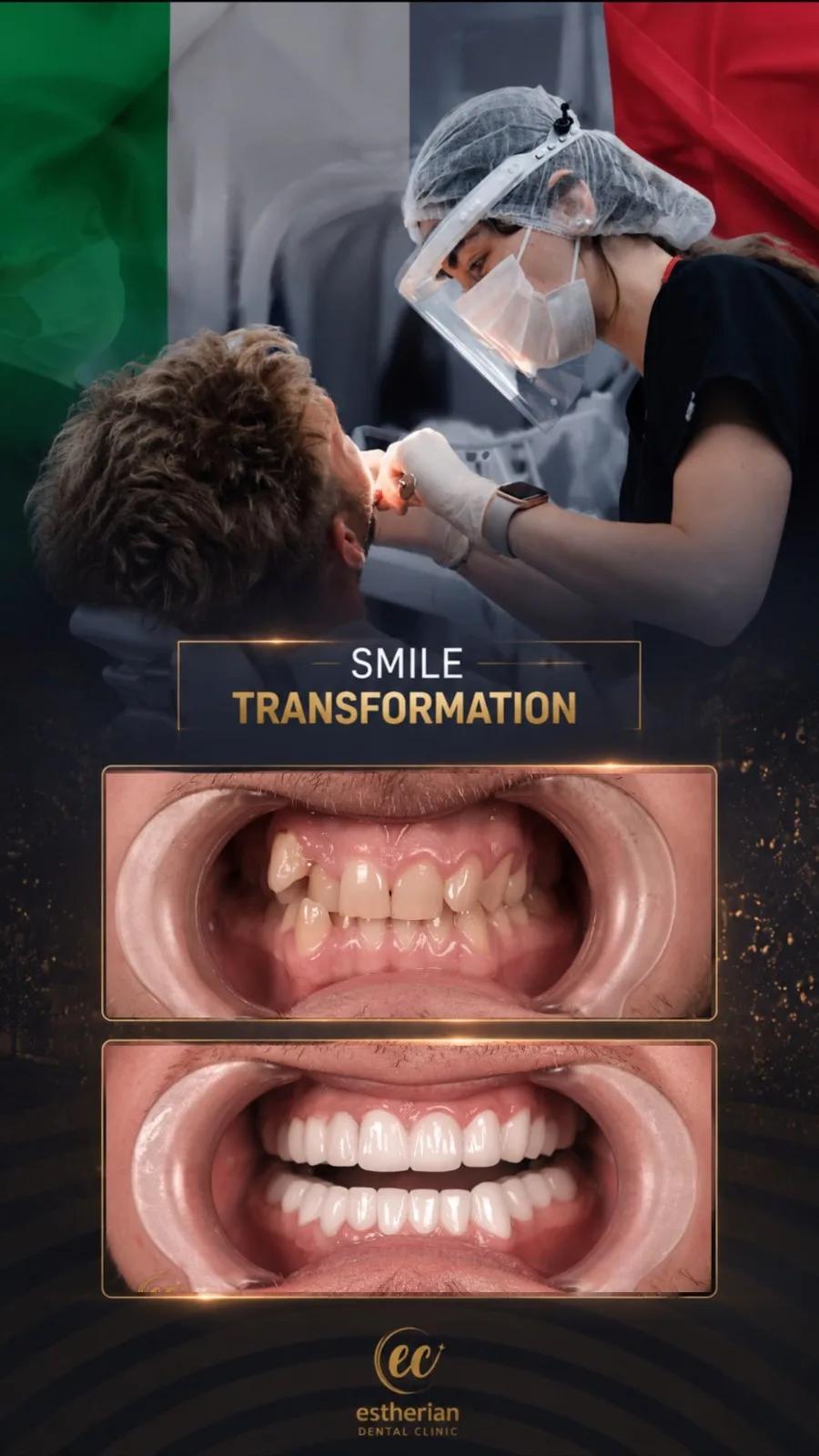 Dental surgery Istanbul Before and after 