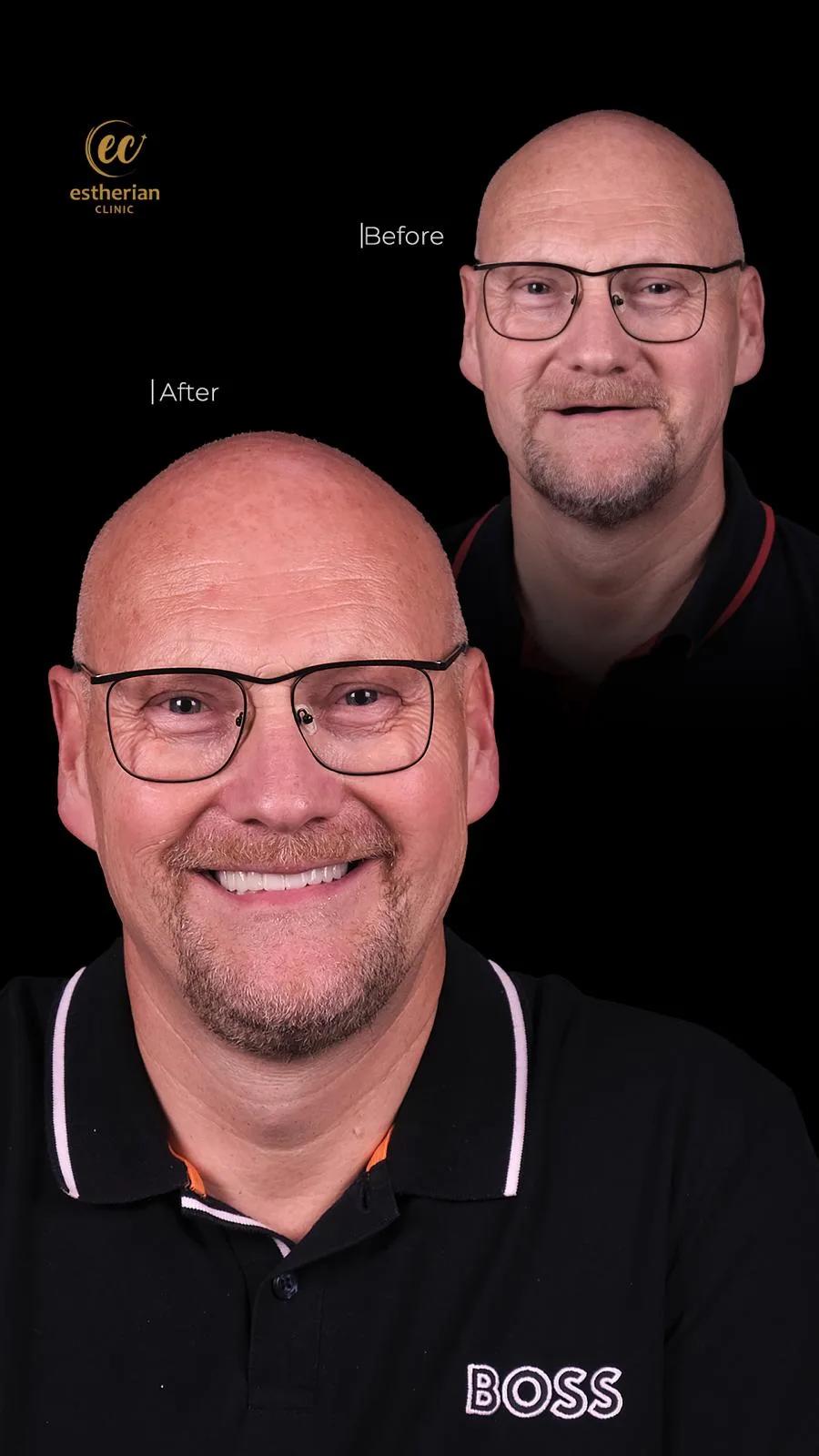 Dental surgery Istanbul Before and after 