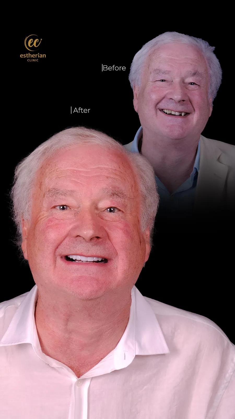 Dental surgery Istanbul Before and after 