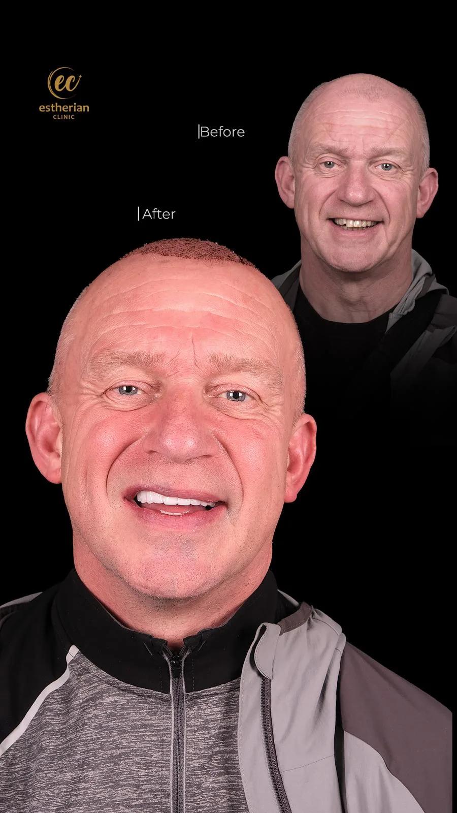 Dental surgery Istanbul Before and after 