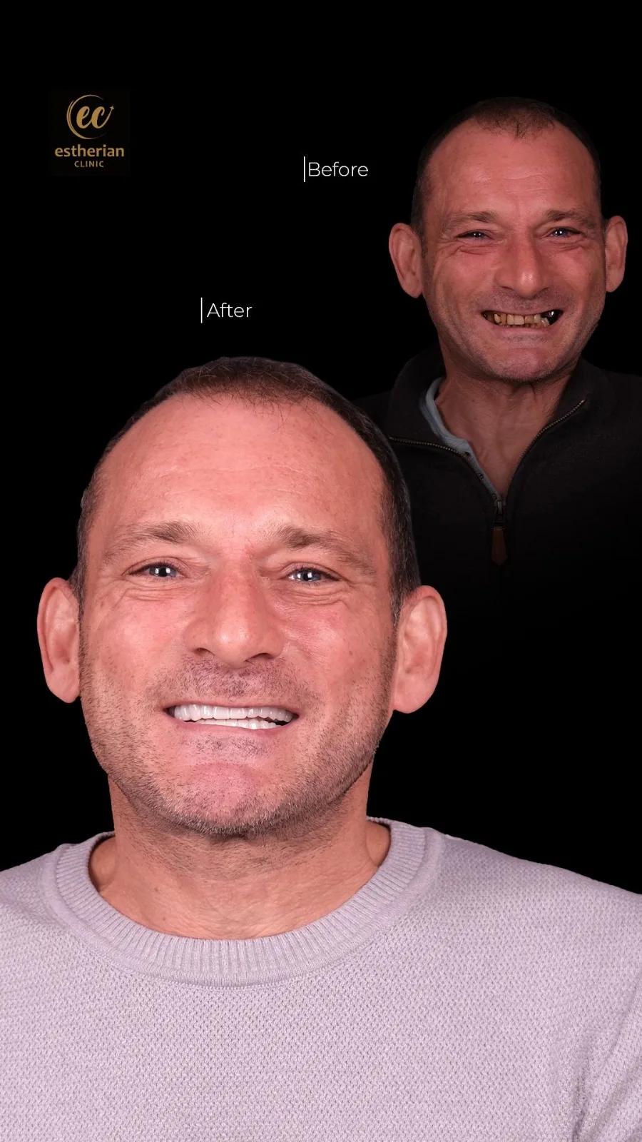 Dental surgery Istanbul Before and after 
