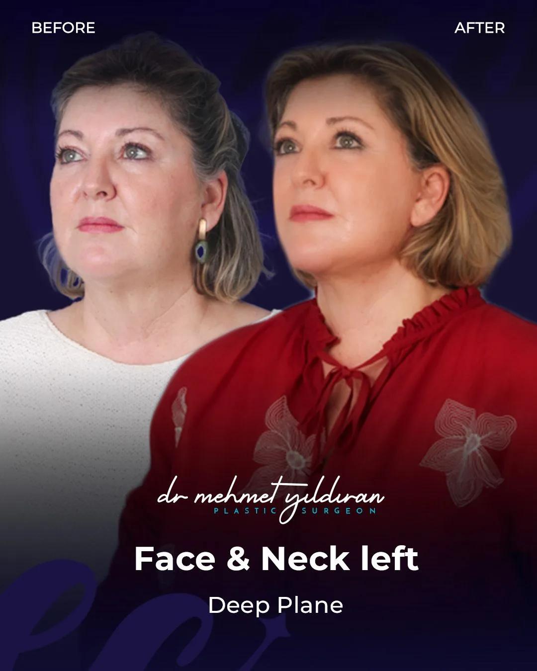  Face lift Turkey 
