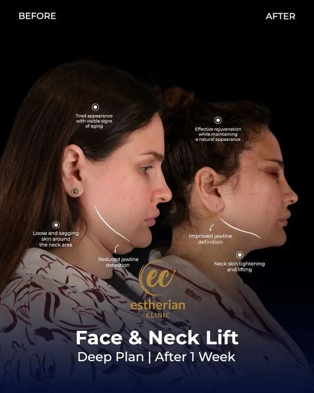  Face lift Turkey 