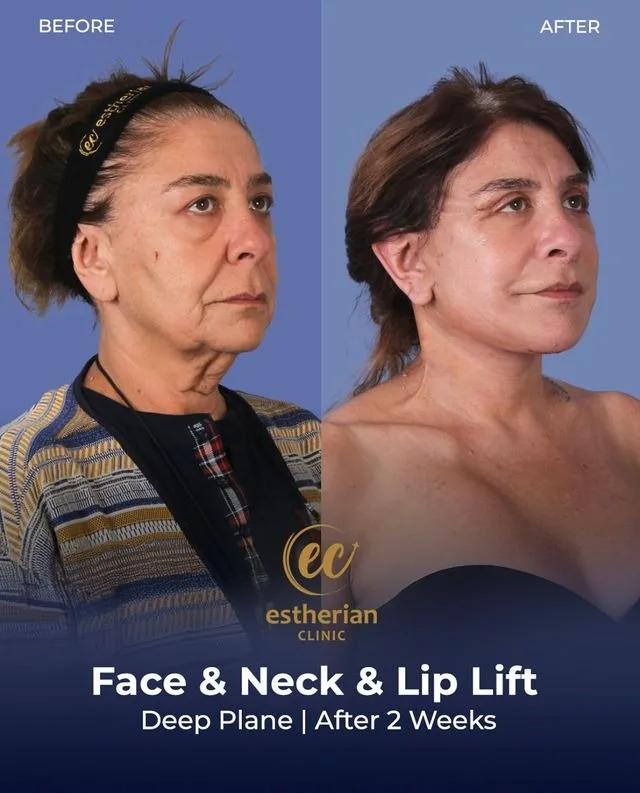  Face lift Turkey 