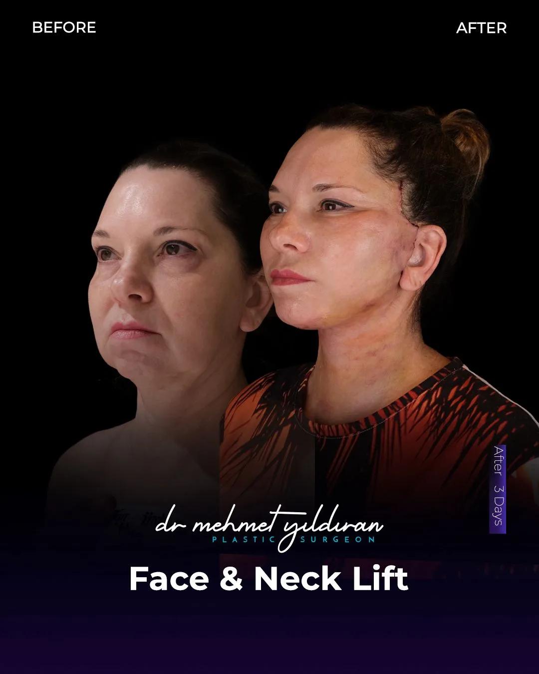  Face lift Turkey 
