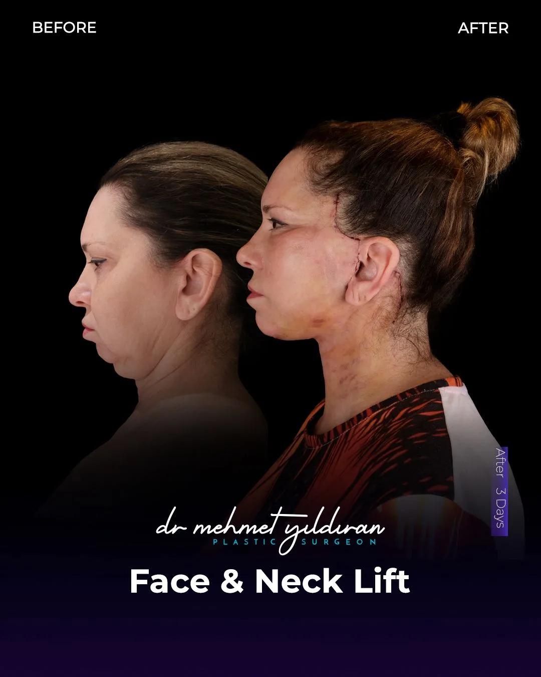  Face lift Turkey 