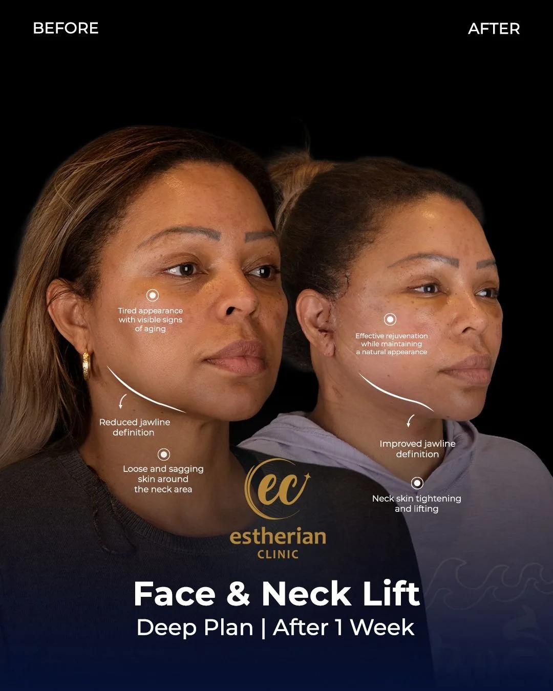  Face lift Turkey 