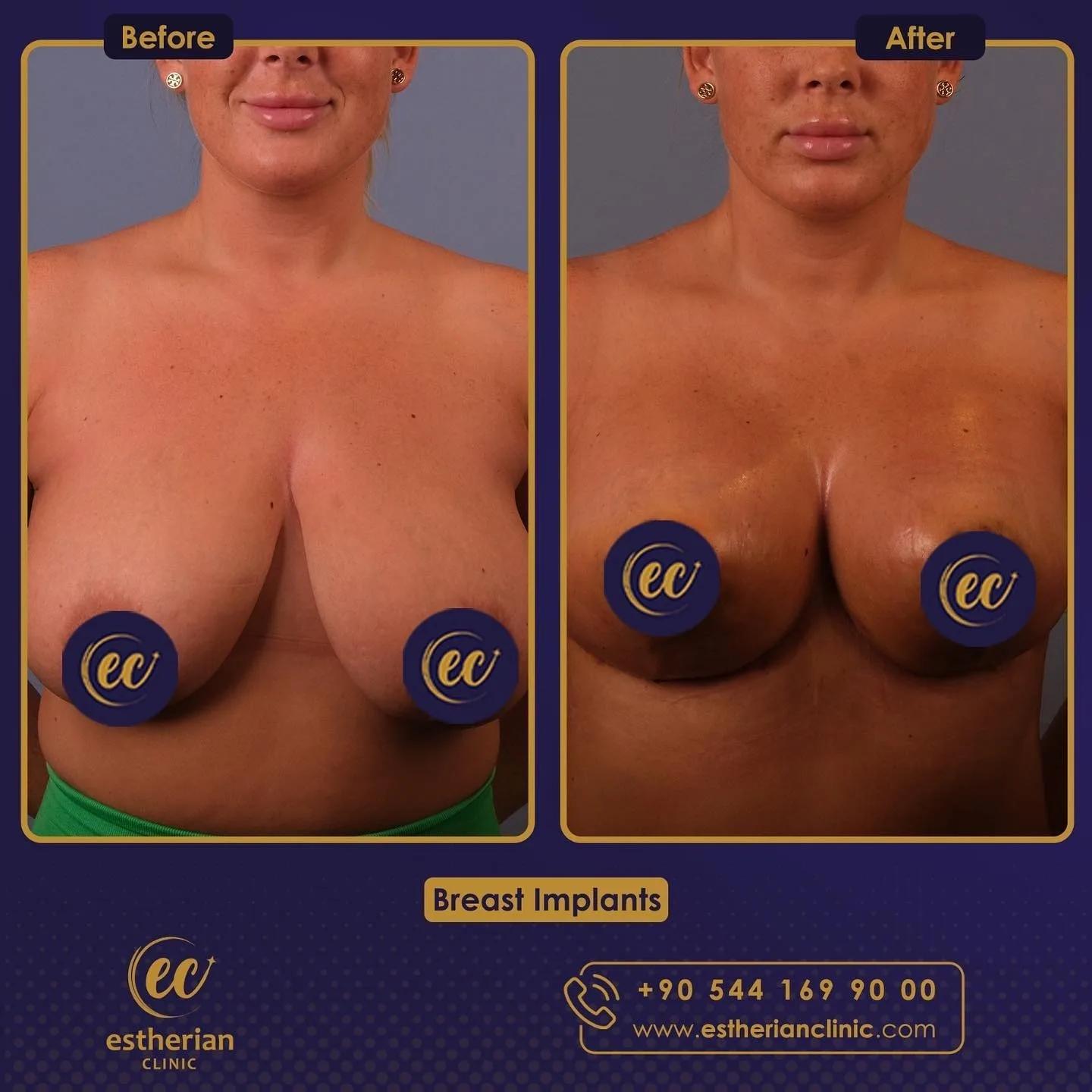 estherian Breast Surgery 10