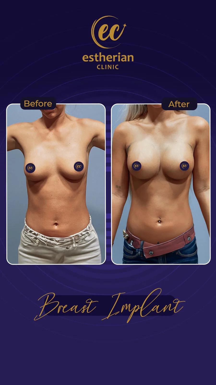 estherian Breast Surgery 10