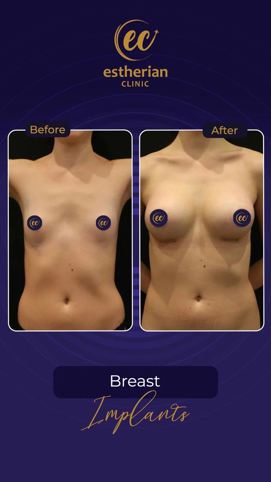 estherian Breast Surgery 10
