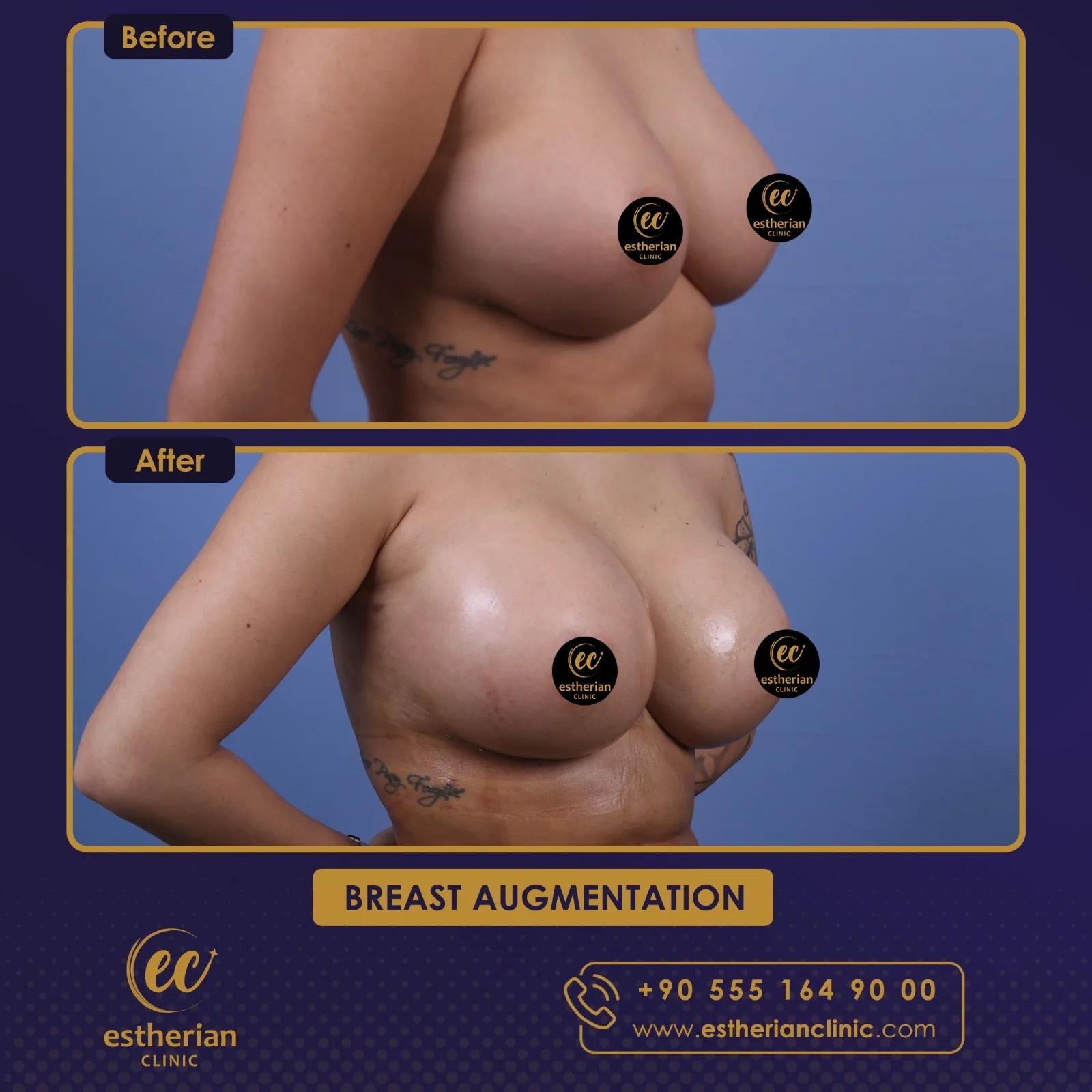 estherian Breast Surgery 10