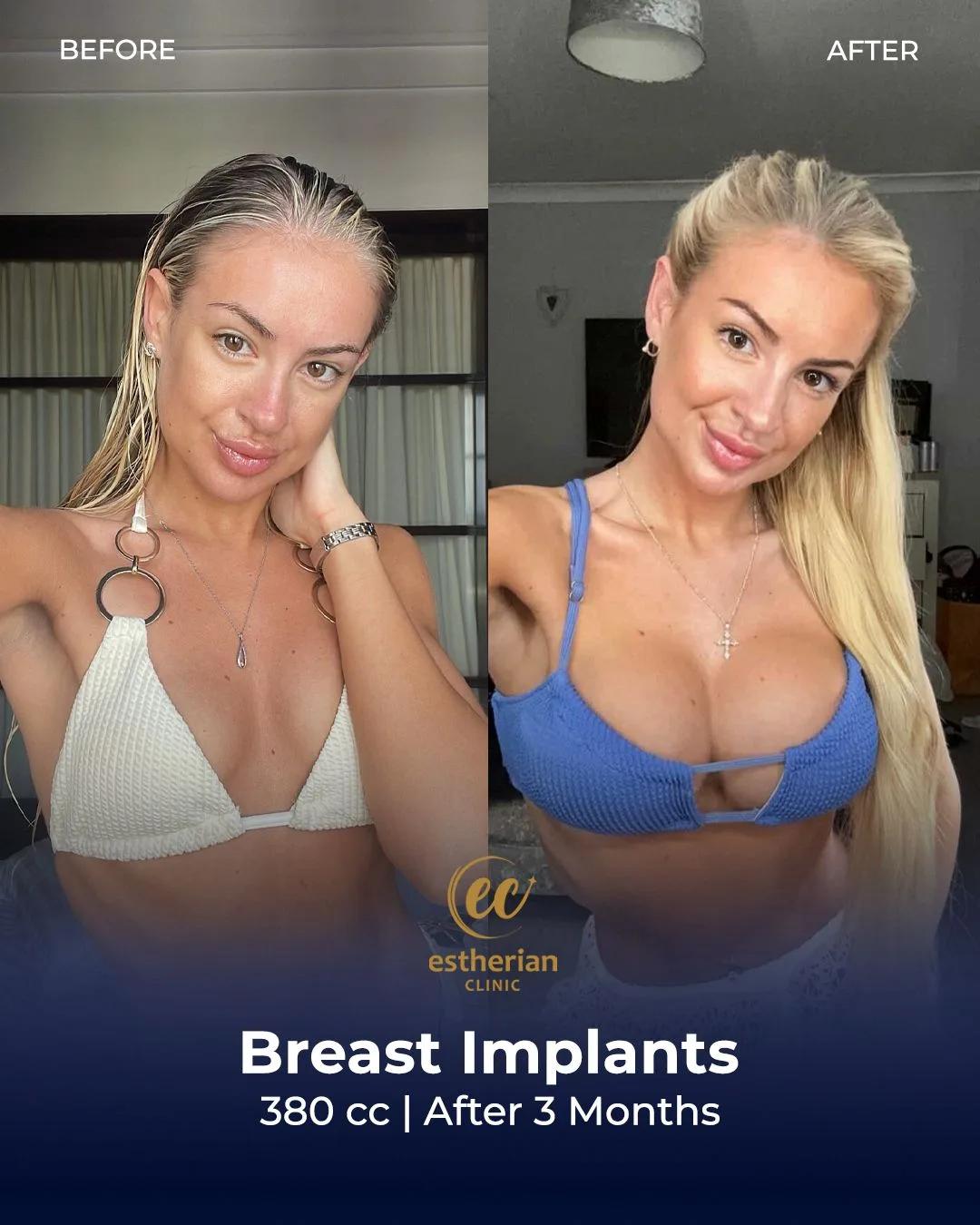 N9cqXOdestherian Breast Surgery 10nAUrrSmuGG7CnVtWlFaPHz1XSbfib0NFV