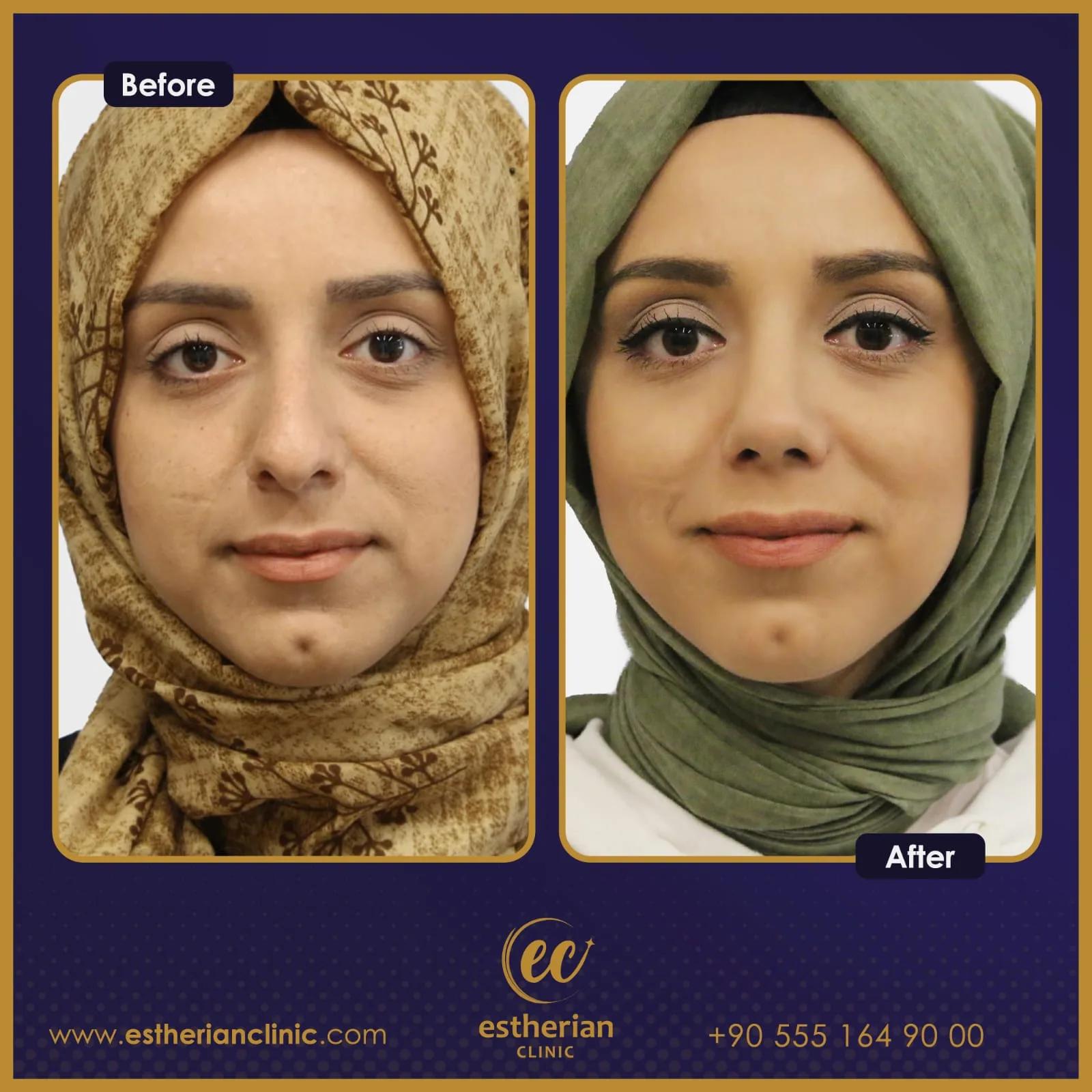 estherian Face Surgery 3