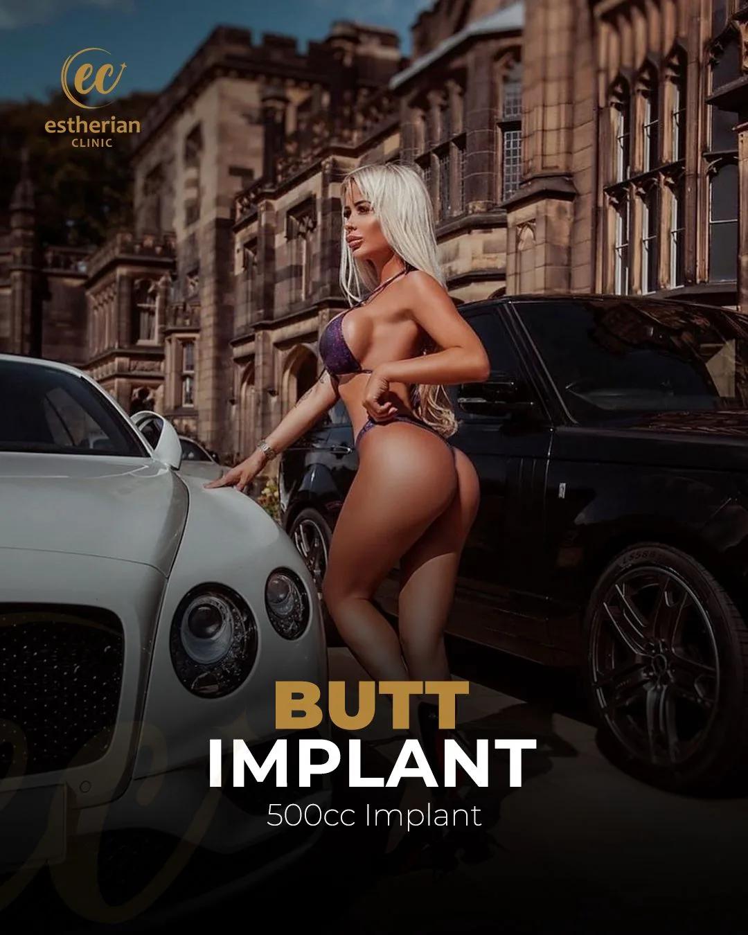 Buttocks Implants Turkey 7fsTKb1i3e3U2J9PbPOcRCp9WrJUHvellzJf0wfi