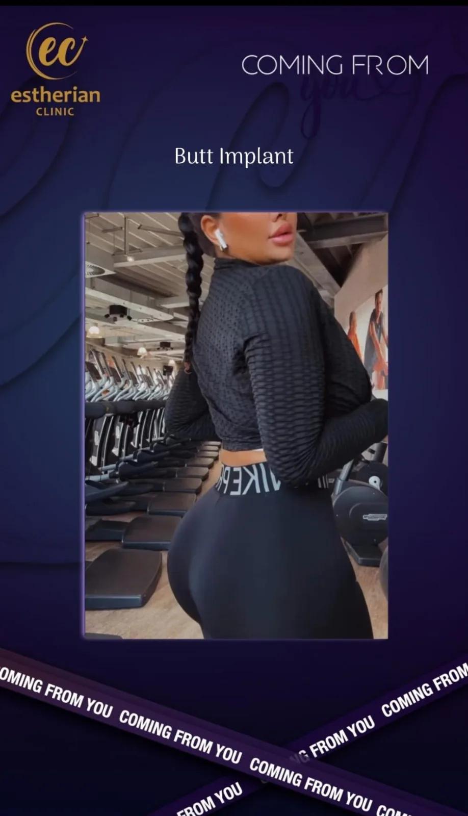 Buttocks Implants Turkey 