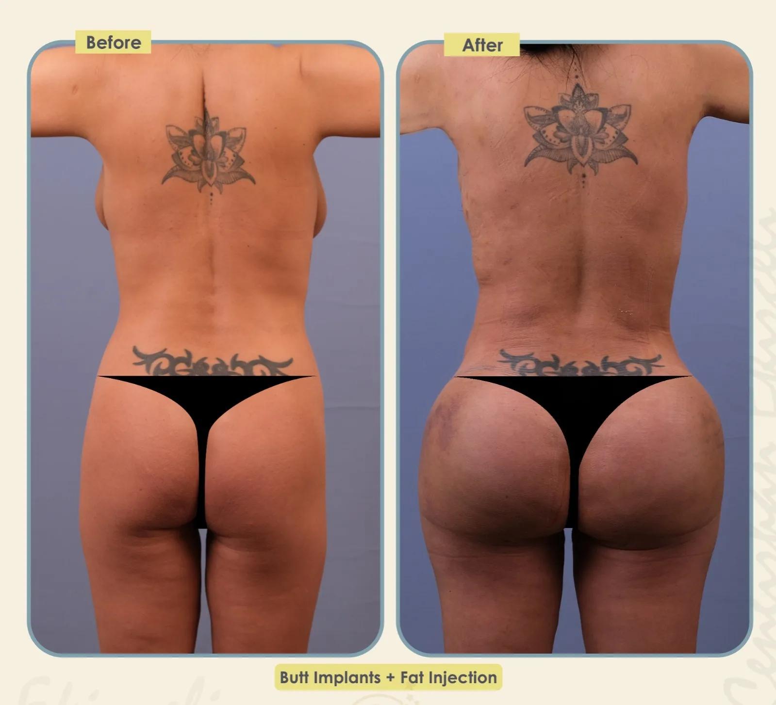 Buttocks Implants Turkey 
