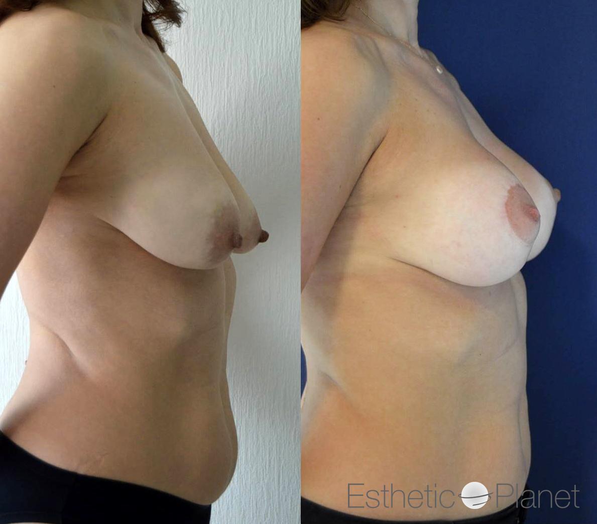 Lifting des seins, breast lift by Dr Ergin Er 