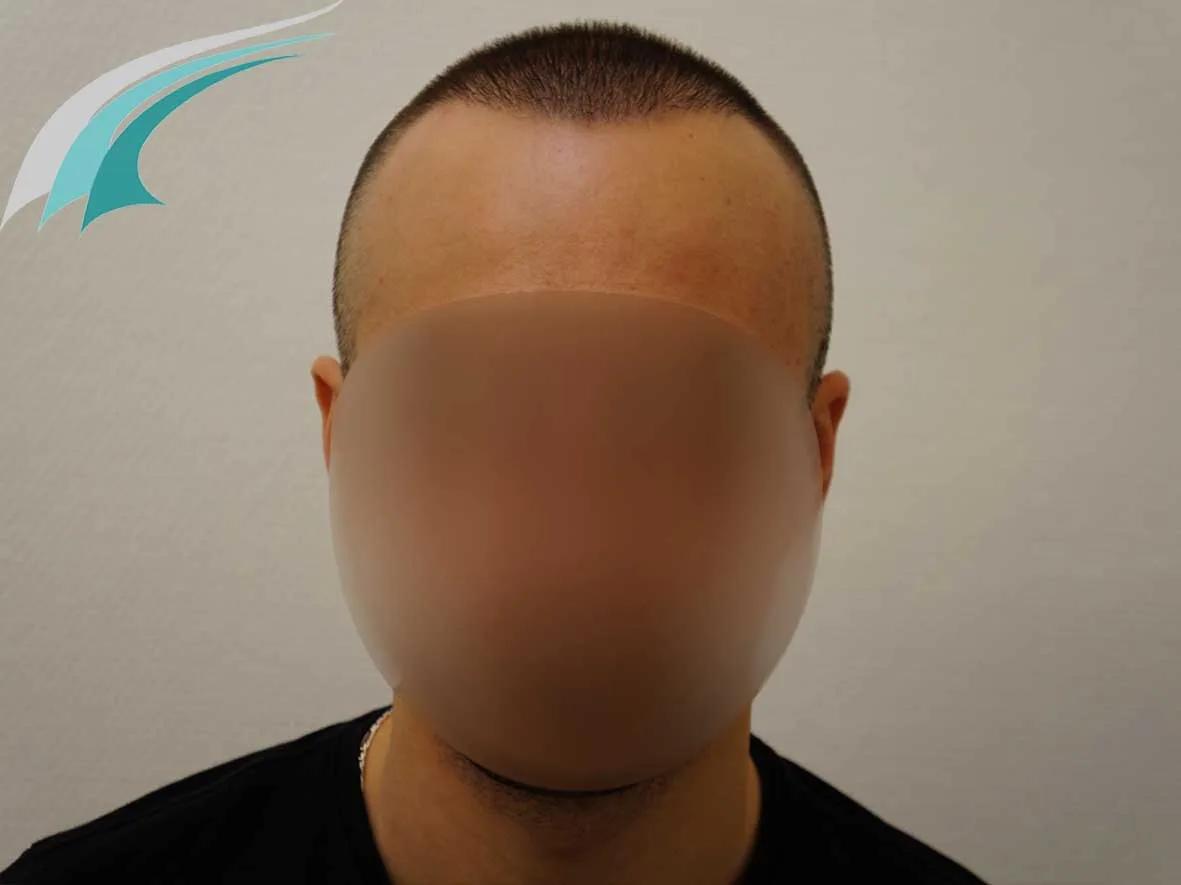 FUE by Doctors