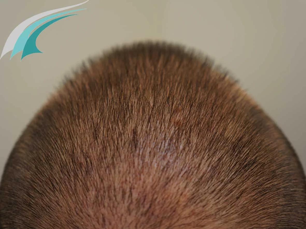 FUE by Doctors