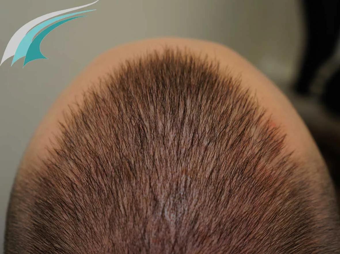 FUE by Doctors