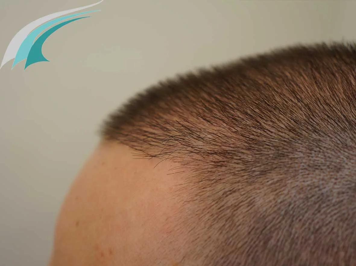 FUE by Doctors