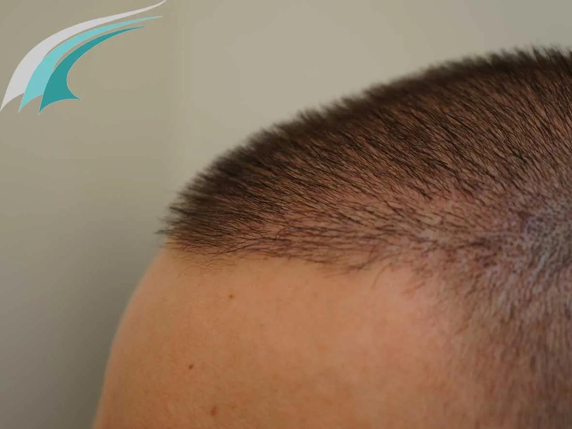 FUE by Doctors