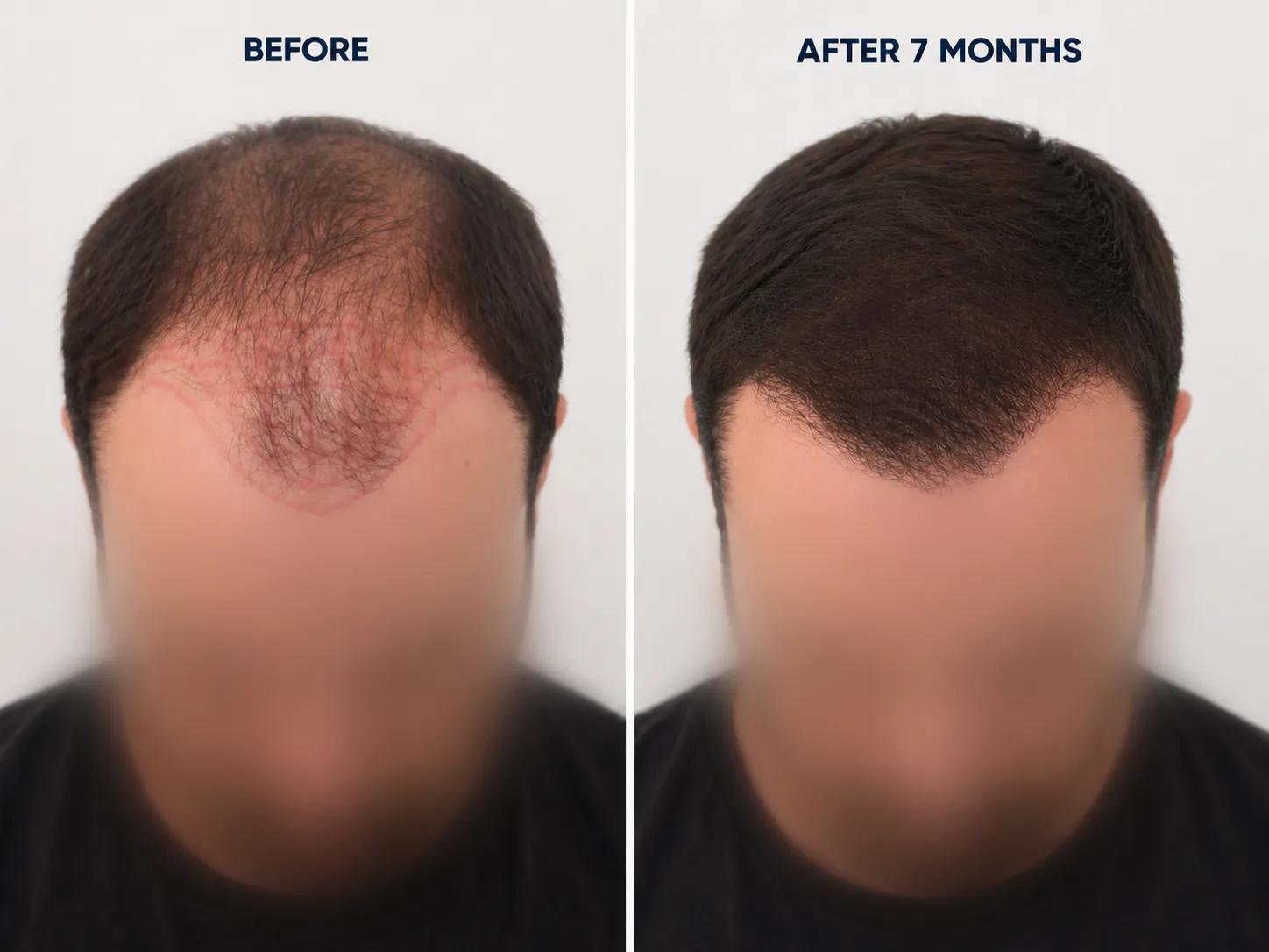 FUE by Doctors