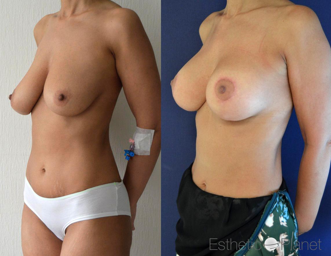 Lifting des seins, breast lift by Dr Ergin Er 