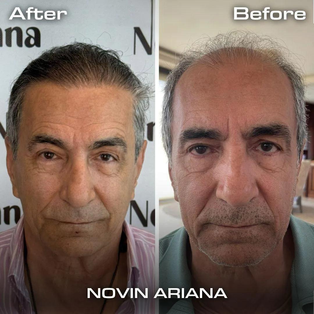 FUE Sapphire - Novin Ariana BHT Hospital - Istanbul - Turkey 1