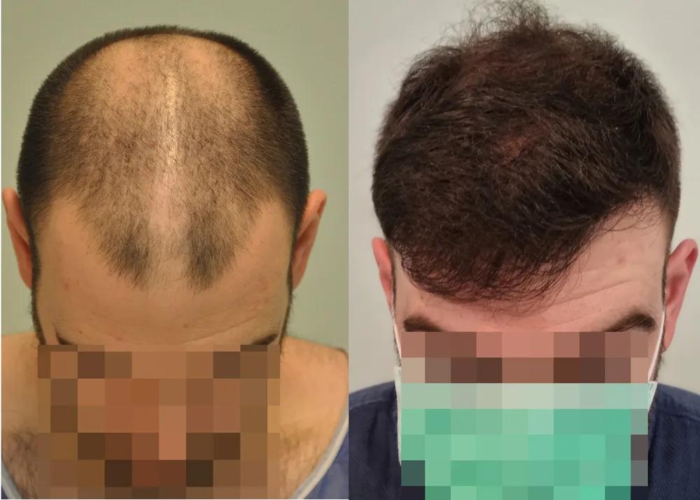 FUE by Doctor