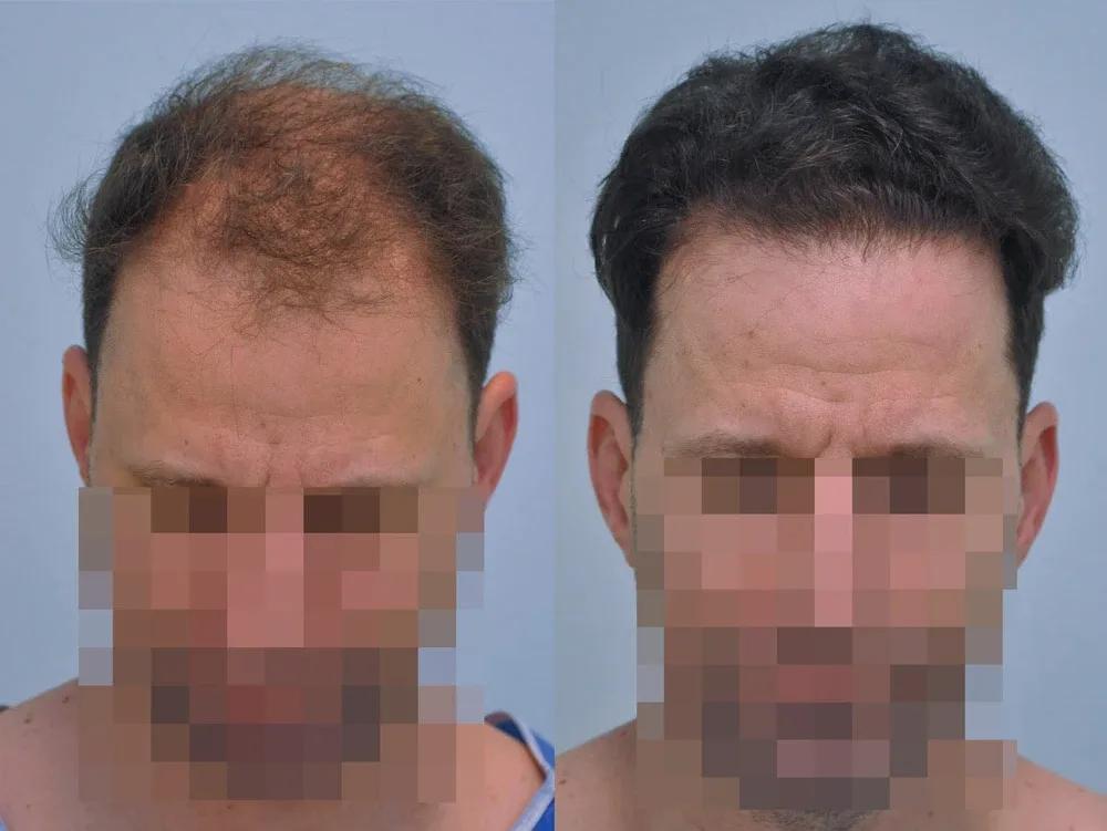 FUE by Doctor