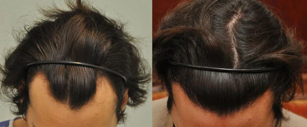 FUE by Doctor