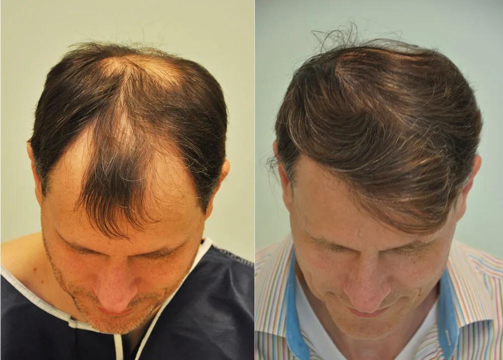 FUE by Doctor
