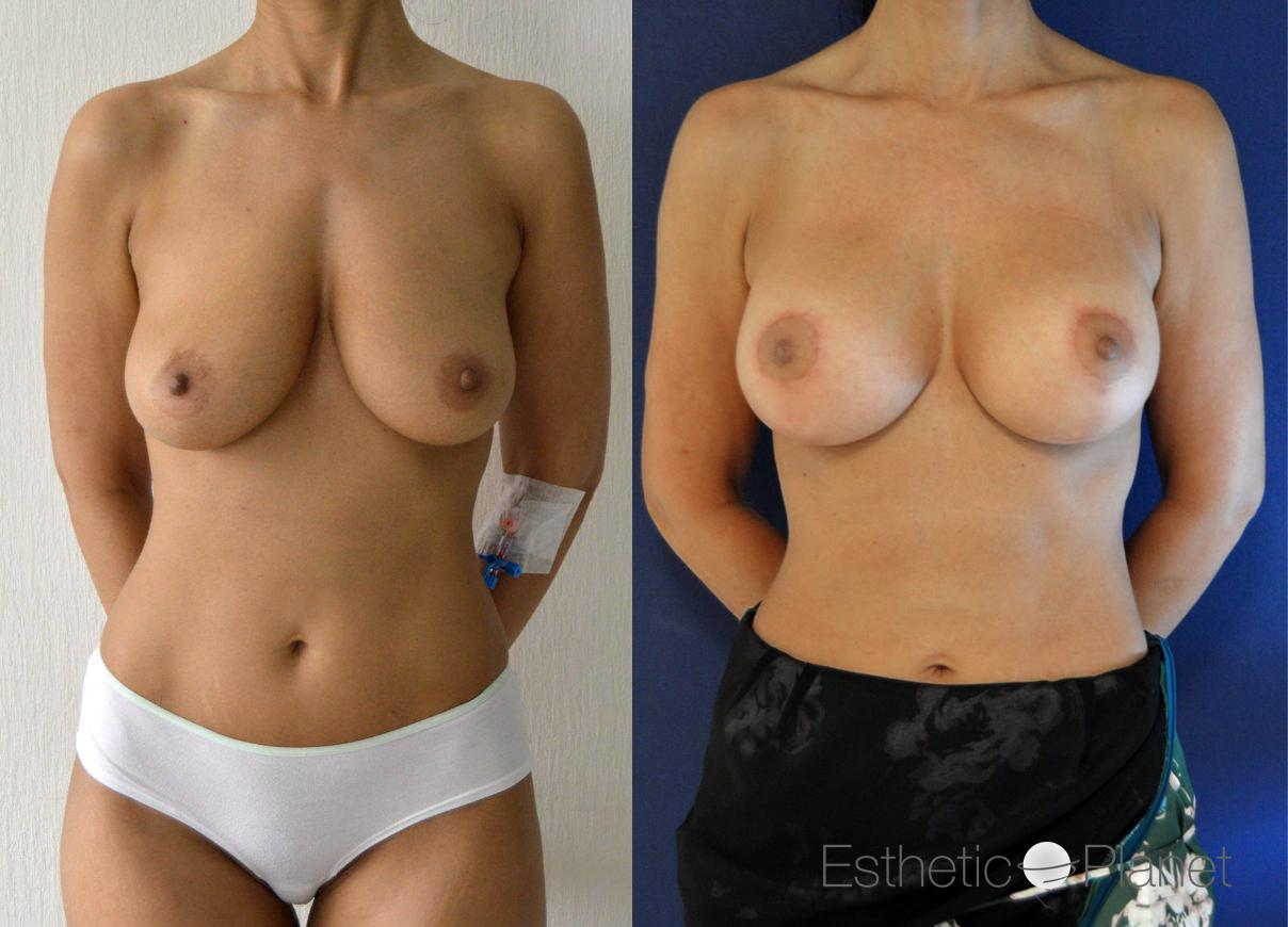 Lifting des seins, breast lift by Dr Ergin Er 