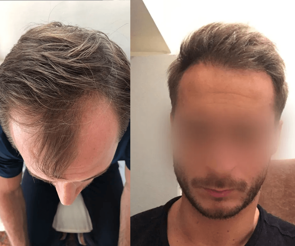 Avant Après 3500 FUE DR BEYHAN 2800 GREFFES